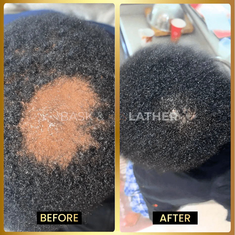 Scalp Stimulator | Hair Growth Oil