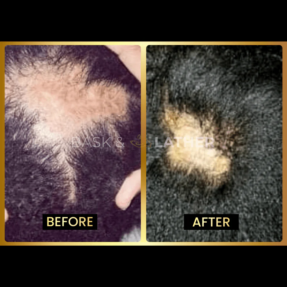 Scalp Stimulator | Hair Growth Oil