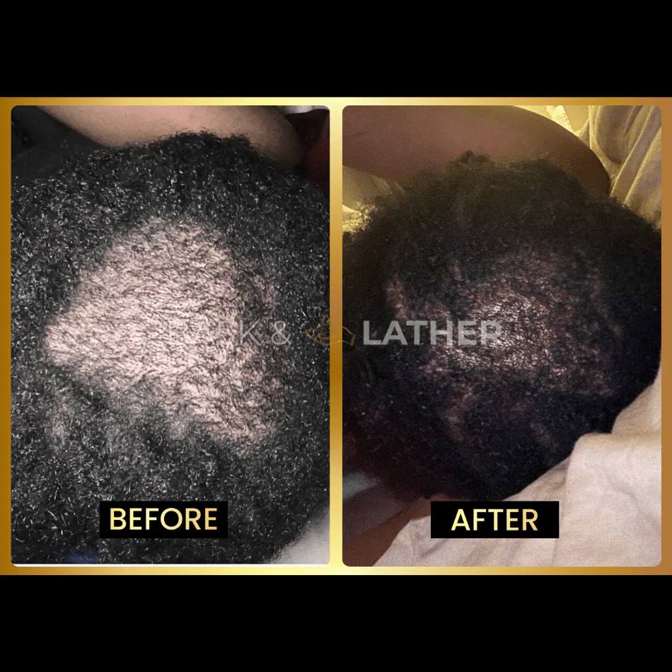 Scalp Stimulator | Hair Growth Oil